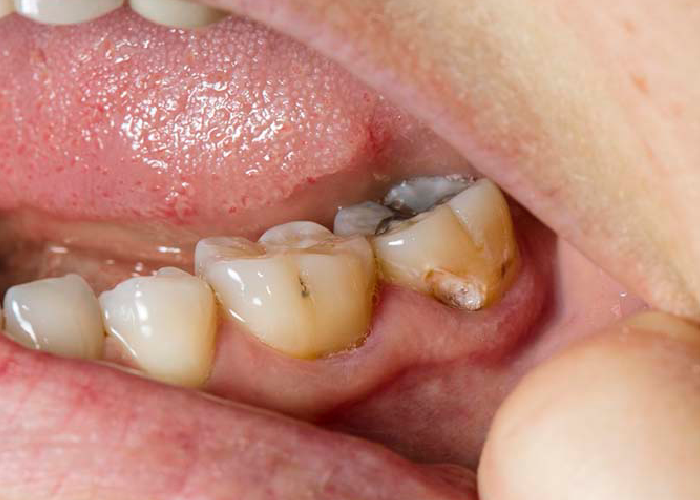 How to Prevent Cavities: Simple Habits for Healthy Teeth