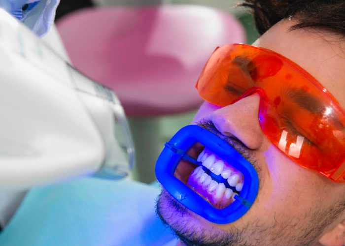 Teeth Whitening: Safe Ways to Brighten Your Smile
