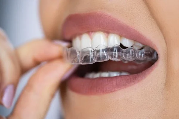 Invisible_aligners_1 (1)